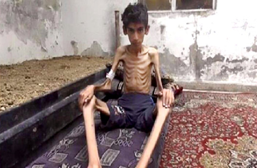 Desnutricion en siria